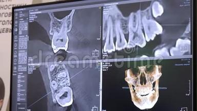 3D牙科数字<strong>建模</strong>修复.. 三维牙齿模型，病人扫描牙齿。 医生正在研究